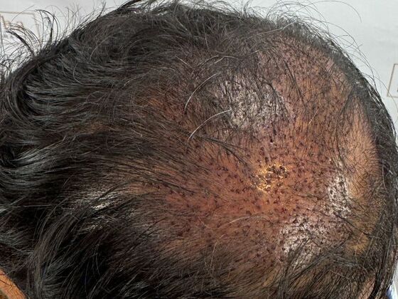 FUE Hair Restoration: Case 45 - Before