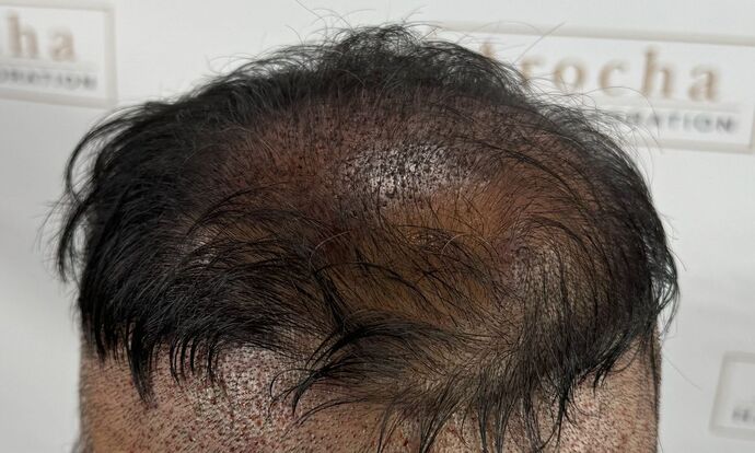 FUE Hair Restoration: Case 45 - Before