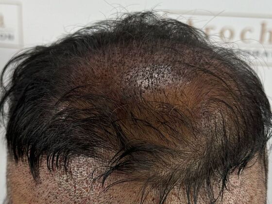 FUE Hair Restoration: Case 45 - Before
