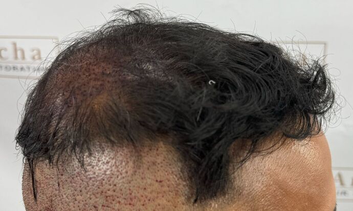 FUE Hair Restoration: Case 45 - Before