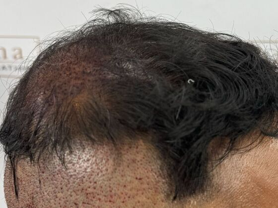 FUE Hair Restoration: Case 45 - Before