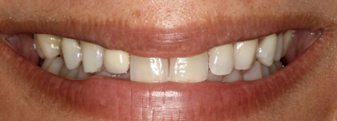 Smile Makeover & Veneers: Jillian - Before