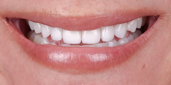 Smile Makeover & Veneers: Jillian - After