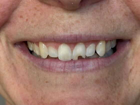 Porcelain Veneers: Case 39 - Before