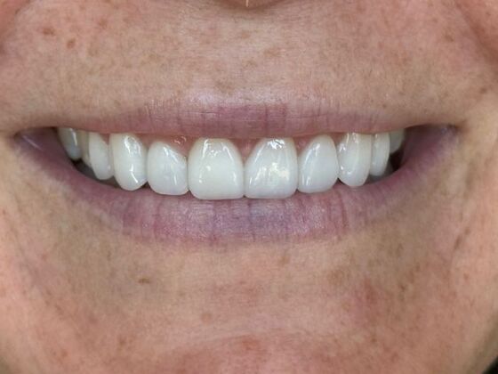 Smile Makeovers Case 28 - After