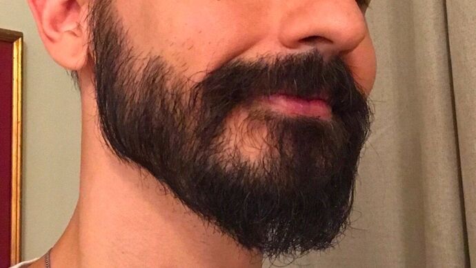 Facial Hair Transplantation Case 9 - After