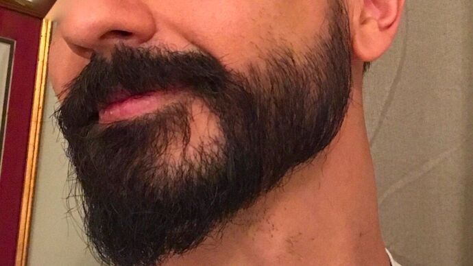 Facial Hair Transplantation: Case 9 - After