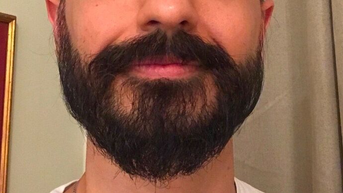 Facial Hair Transplantation: Case 9 - After