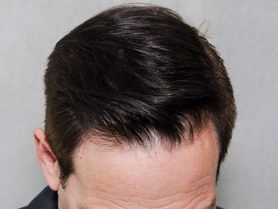 Hair Transplant Results Cases
