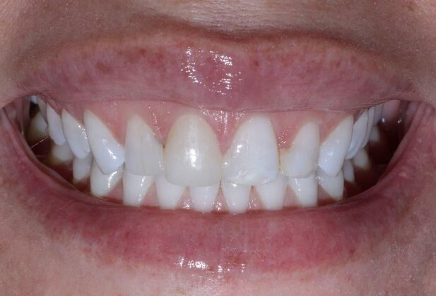 Smile Makeover & Veneers: Havona - Before