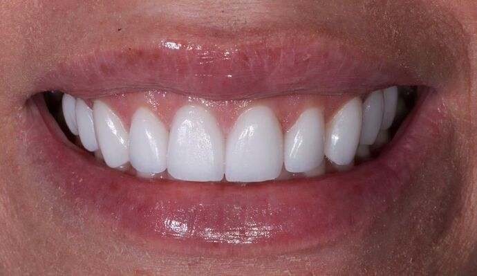 Smile Makeover & Veneers: Havona - After