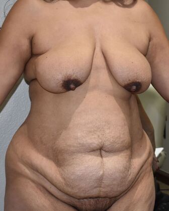 Mommy Makeover: Case 331 - Before