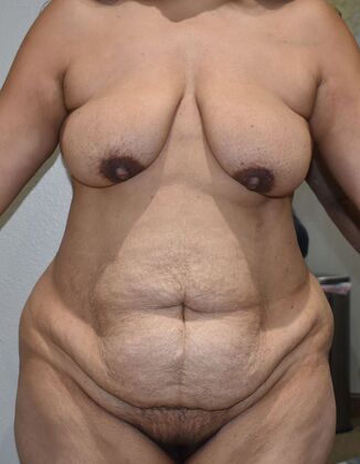 Mommy Makeover Case 331 - Before