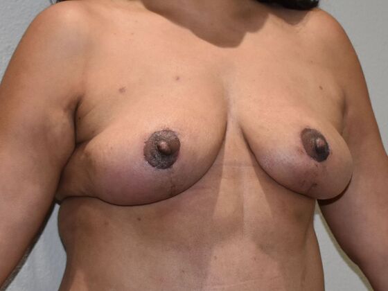 Breast Lift (Mastopexy): Case 234 - After