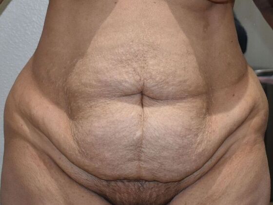 Tummy Tuck (Abdominoplasty): Case 521 - Before