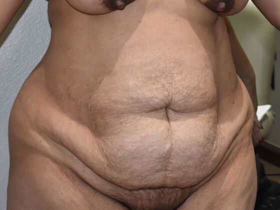 Tummy Tuck (Abdominoplasty): Case 521 - Before