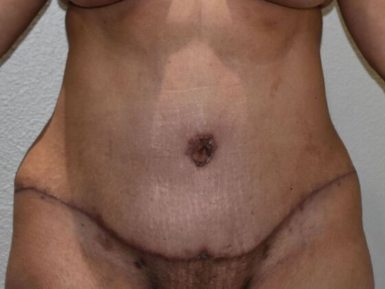 Tummy Tuck (Abdominoplasty): Case 521 - After