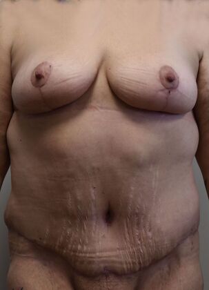 Mommy Makeover Case 332 - After