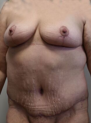 Mommy Makeover: Case 332 - After