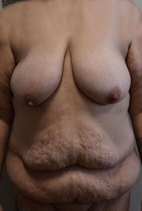 Mommy Makeover Case 332 - Before