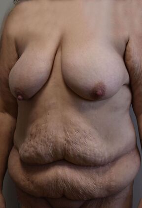 Mommy Makeover: Case 332 - Before