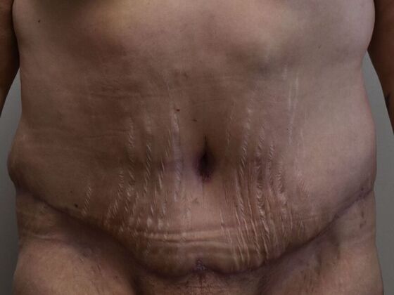 Tummy Tuck (Abdominoplasty): Case 522 - After