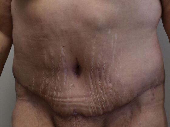 Tummy Tuck (Abdominoplasty): Case 522 - After