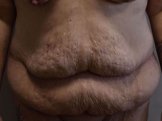 Tummy Tuck (Abdominoplasty): Case 522 - Before