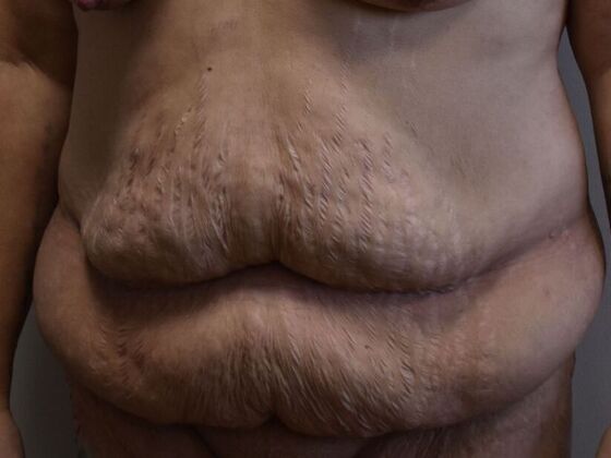 Tummy Tuck (Abdominoplasty): Case 522 - Before