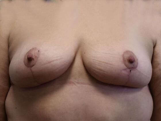 Breast Lift (Mastopexy) Case 235 - After