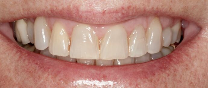 Smile Makeover & Veneers: Britney - Before