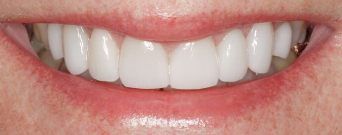 Smile Makeover & Veneers: Britney - After