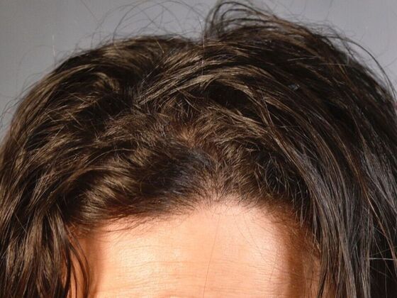 FUT Hair Restoration: Case 48 - Before