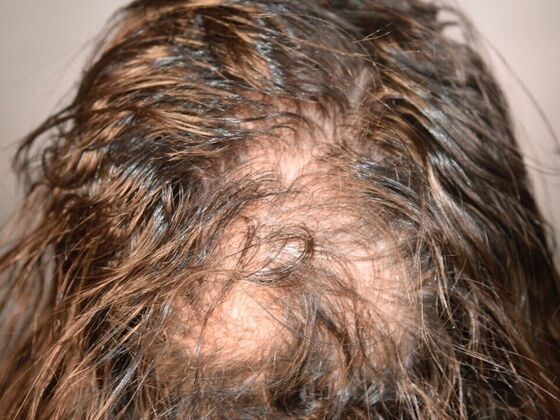 FUT Hair Restoration: Case 48 - Before