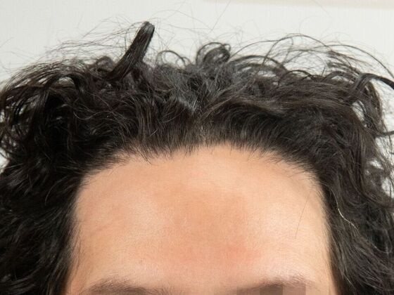 FUT Hair Restoration: Case 48 - After