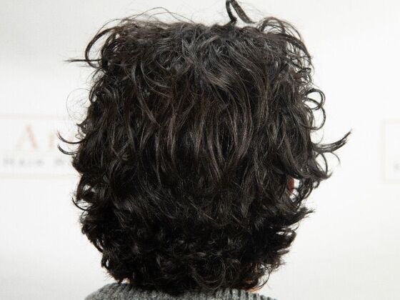 FUT Hair Restoration Case 48 - After