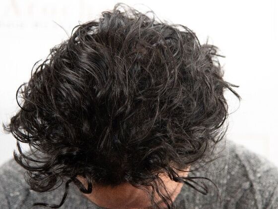 FUT Hair Restoration: Case 48 - After