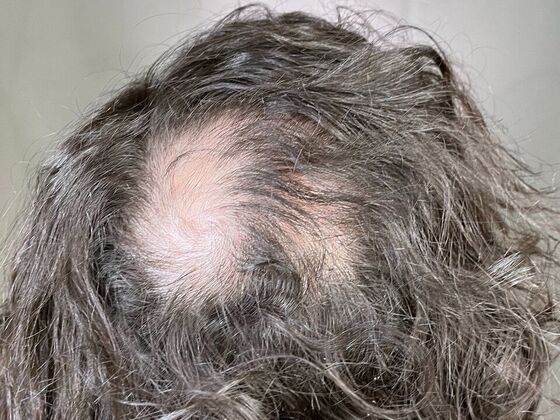 FUT Hair Restoration Case 48 - Before