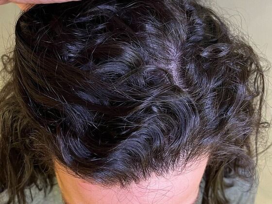 FUT Hair Restoration: Case 48 - Before