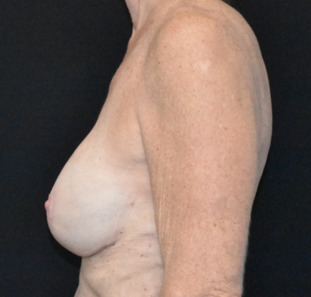 Mastopexy with Augmentation: Case 16 - After