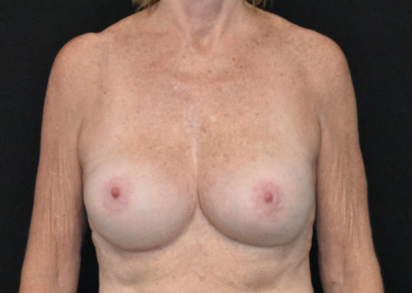 Mastopexy with Augmentation: Case 16 - After