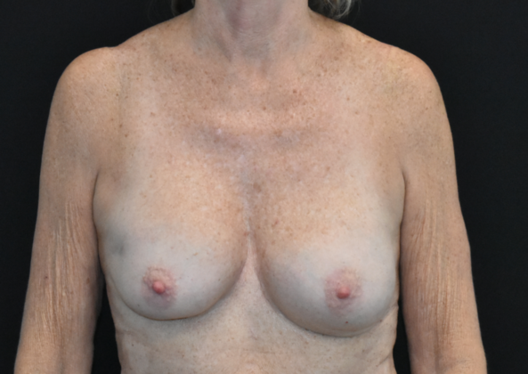 Mastopexy with Augmentation: Case 16 - Before