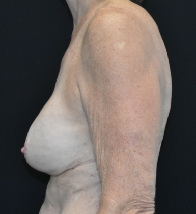 Mastopexy with Augmentation: Case 16 - Before