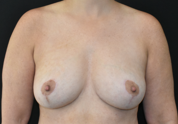 Mastopexy Case 6 - After