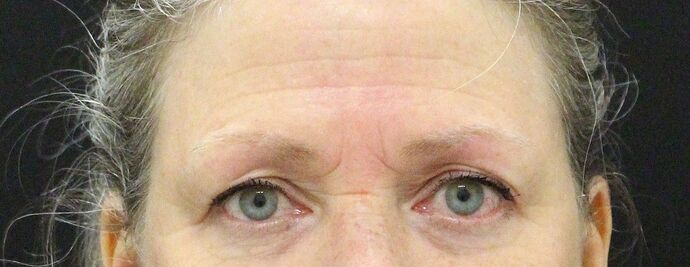 Eyelid Surgery Case 16 - Before