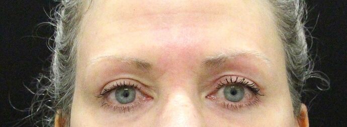 Eyelid Surgery Case 16 - After
