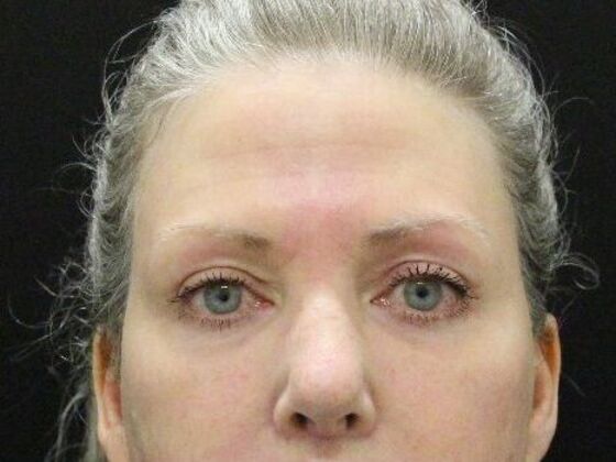 Forehead & Brow Lifts Case 3 - After