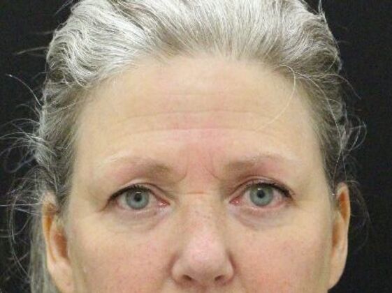 Forehead & Brow Lifts Case 3 - Before