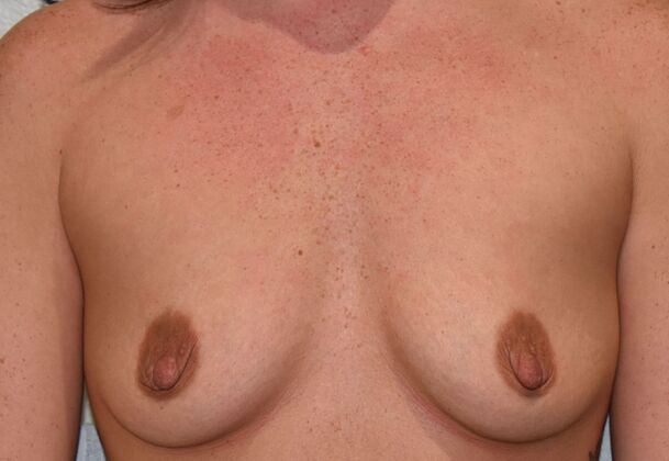 Breast Augmentation Case 785 - Before