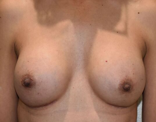 Breast Augmentation Case 777 - After